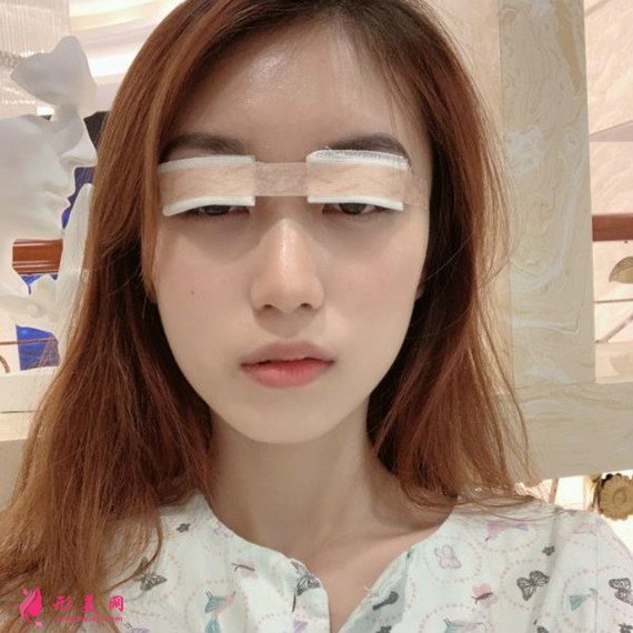 做了全切雙眼皮手術后再也不用麻煩的雙眼皮貼了 做了全切雙眼皮手術后再也不用麻煩的雙眼皮貼了