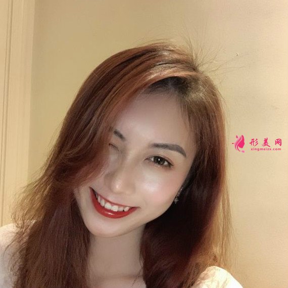 做了全切雙眼皮手術后再也不用麻煩的雙眼皮貼了 做了全切雙眼皮手術后再也不用麻煩的雙眼皮貼了