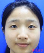 深圳北大李天石雙眼皮案例分享：給了很大的改變，顏值上升