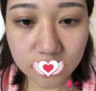 上海九院雙眼皮怎么樣？手術案例，60天后來做恢復經驗分享