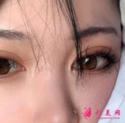 八大處宋濤雙眼皮修復怎么樣？案例效果親身體驗