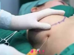 自體脂肪隆胸需要注意的風(fēng)險(xiǎn)問(wèn)題？