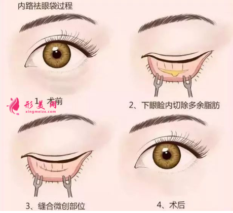 手術(shù)祛眼袋術(shù)后有哪些注意事項(xiàng)