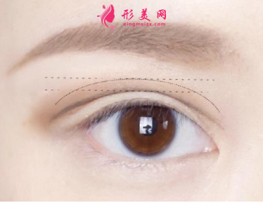 做雙眼皮手術(shù)會有疤痕出現(xiàn)嗎