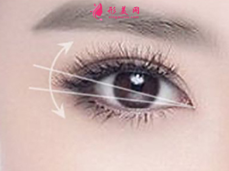 做開(kāi)眼角手術(shù)會(huì)影響視力嗎