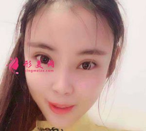 南京美貝爾整形醫(yī)院自體脂肪面填案例