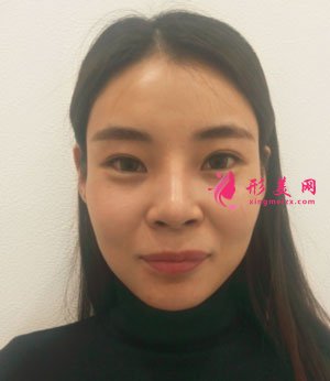 南京美貝爾整形醫(yī)院自體脂肪面填案例