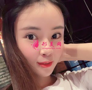 南京美貝爾整形醫(yī)院自體脂肪面填案例