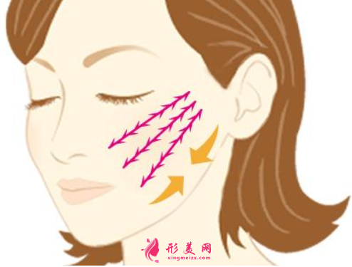面部埋線后多久消腫