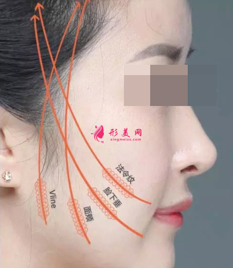 面部埋線后多久消腫