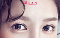 近視眼可以做雙眼皮手術(shù)嗎？