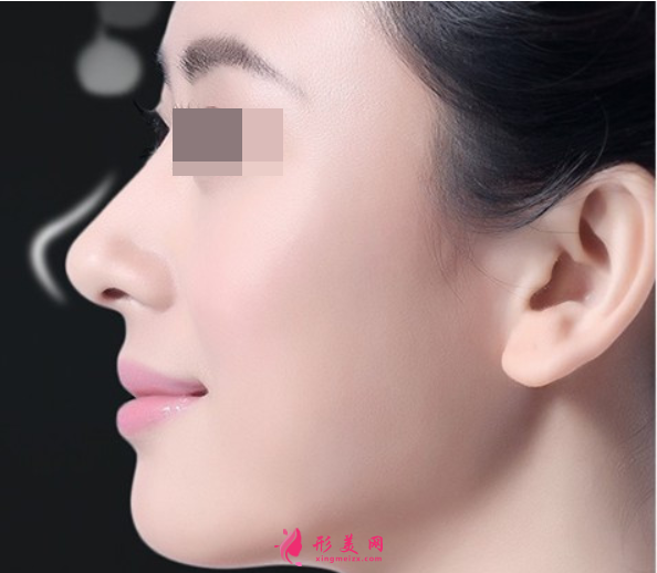 假體隆鼻以后還可以取出來嗎