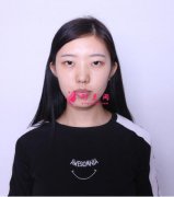 唐都醫(yī)院李望舟雙眼皮案例，漂亮美眉眼神也不能丟~