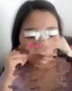 北京雙眼皮修復(fù)多少錢？看我在北京京明做的修復(fù)案例