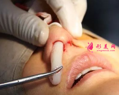 隆鼻假體取出費(fèi)用是多少
