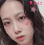 北京八大處楊明勇醫(yī)生雙眼皮案例效果圖展示