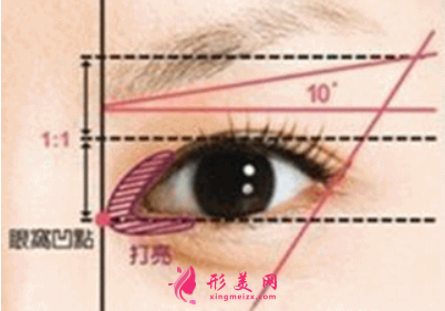 開眼角手術(shù)到底安不安全