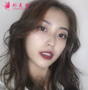 上海第九人民醫(yī)院整形科面部脂肪填充效果咋樣?實(shí)拍圖分享
