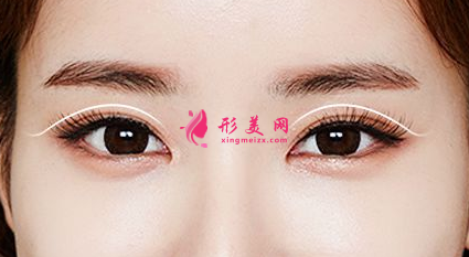 雙眼皮整形的費(fèi)用是多少