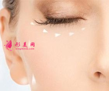 切除眼袋手術怎么樣