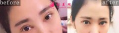 沈陽伊美爾雙眼皮好嗎？術(shù)后60天真人案例分享