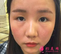 重慶時(shí)光整形做雙眼皮怎么樣？術(shù)后三個(gè)月真人案例分享！