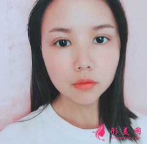 重慶時(shí)光整形美容醫(yī)院切開雙眼皮案例