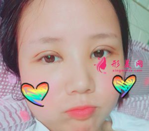 重慶時(shí)光整形美容醫(yī)院切開雙眼皮案例
