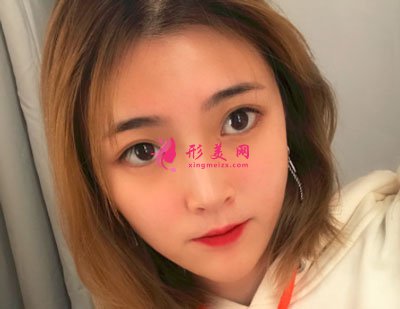 南京美貝爾整形醫(yī)院手術(shù)縮鼻翼案例