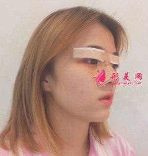南京美貝爾整形醫(yī)院手術(shù)縮鼻翼案例
