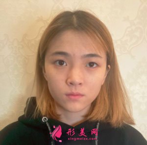 南京美貝爾整形醫(yī)院手術(shù)縮鼻翼案例