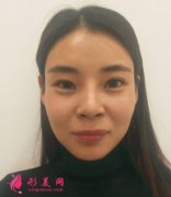 南京美貝爾自體脂肪面部填充，術(shù)后一百天案例分享