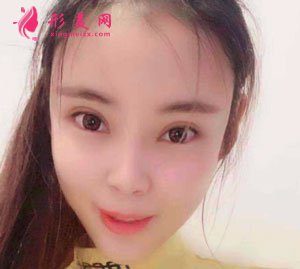 南京美貝爾整形醫(yī)院自體脂肪面填案例