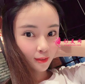 南京美貝爾整形醫(yī)院自體脂肪面填案例