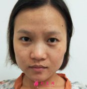 北京歐華水光補(bǔ)水真人案例分享！術(shù)后97天皮膚持續(xù)水水嫩嫩