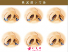 鼻翼縮小整形的恢復時間