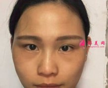 廈門華美醫(yī)療美容做的除皺瘦臉怎么樣？術(shù)后90天真人案例分享