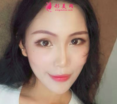 廈門華美醫(yī)療美容門診部除皺瘦臉的案例
