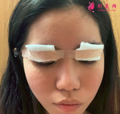 廈門華美醫(yī)療美容門診部眼部多項(xiàng)案例