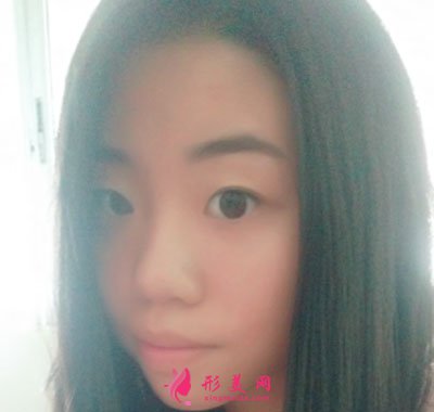 廈門華美醫(yī)療美容門診部眼部多項(xiàng)案例