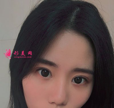 廈門華美醫(yī)療美容門診部眼部多項(xiàng)案例
