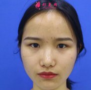 廈門安黛美整形美容做切開雙眼皮怎么樣？術(shù)后三個月對比看效果