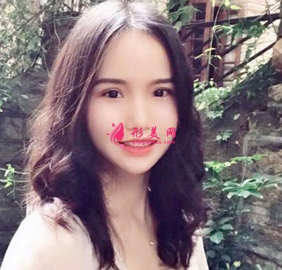 廈門安黛美醫(yī)療整形美容切開雙眼皮案例