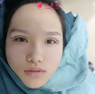 廈門安黛美醫(yī)療整形美容切開雙眼皮案例