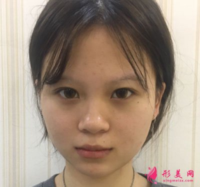 廈門安黛美醫(yī)療整形美容切開雙眼皮案例