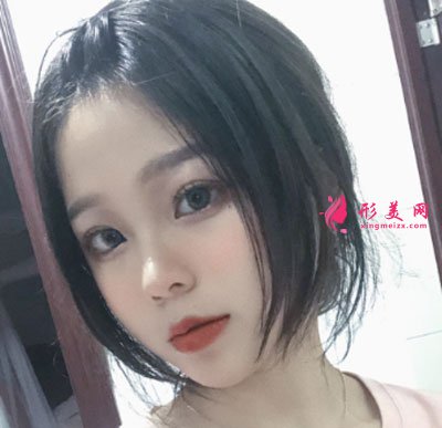廈門安黛美醫(yī)療整形美容切開雙眼皮案例