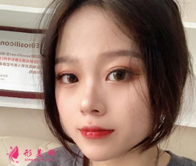 廈門安黛美醫(yī)療整形美容切開雙眼皮案例