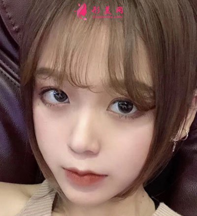 廈門安黛美醫(yī)療整形美容切開雙眼皮案例