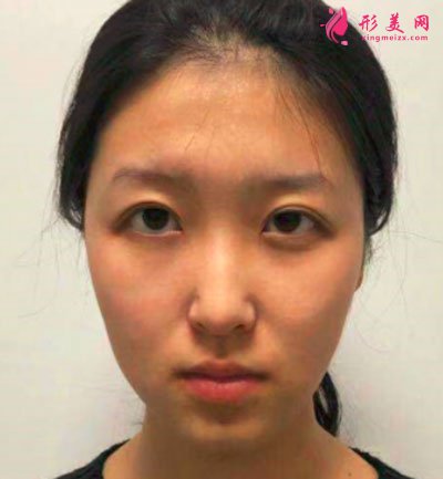 寧波靜港整形自體脂肪面部填充案例