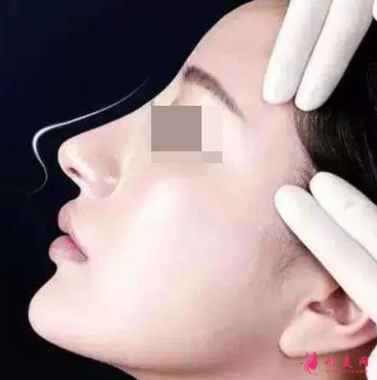 做了假體隆鼻側(cè)睡會(huì)移位嗎